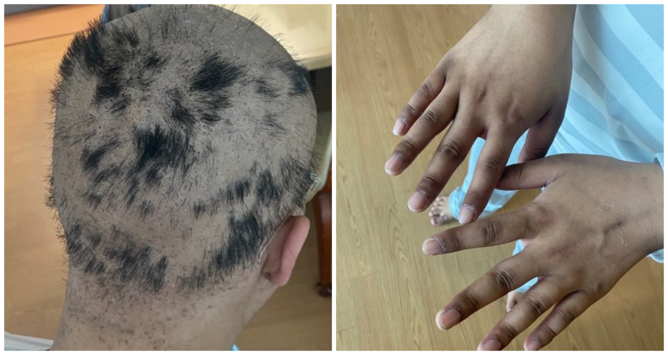 급성 골수 백혈병 진단을 받은 수현(21.가명)씨가 올해 3월 조혈모세포 이식 수술을 받은 뒤, 4월 중순 퇴원해 집에 온 첫날의 사진. 머리카락이 다 빠지고 손이 검게 변했다. / 사진. 수현씨 가족 제공