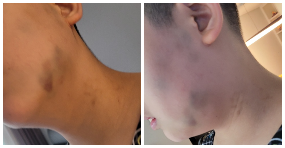 피해 학생 B군(13)의 얼굴과 턱에 피멍이 든 모습(2024.7.17) / 사진 제공.전국장애인부모연대 대구지부