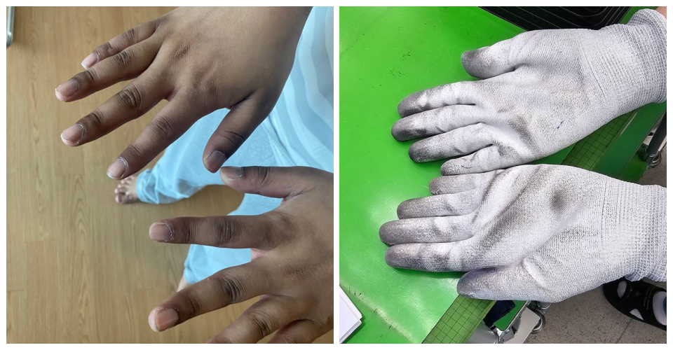 수현(21.가명)씨가 조혈모세포 이식 수술을 받은 뒤 퇴원했을 때 찍은 손이 검게 물든 사진과 지난 5월 공장 현장실사 때 찍은 한 노동자의 검게 물든 장갑 사진 / 사진 제공. 반도체노동자의 건강과 인권지킴이 반올림
