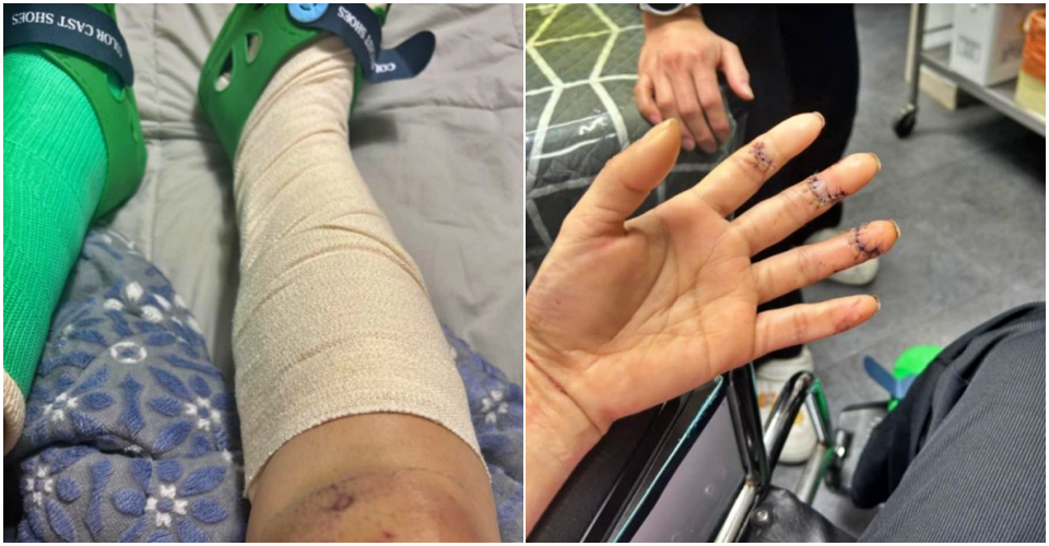 이주노동자들이 단속을 피하려 펜스를 넘으려다 떨어져 양쪽 발이 골절됐고, 손가락을 꿰맨 모습 / 사진 제공.대경이주연대회의